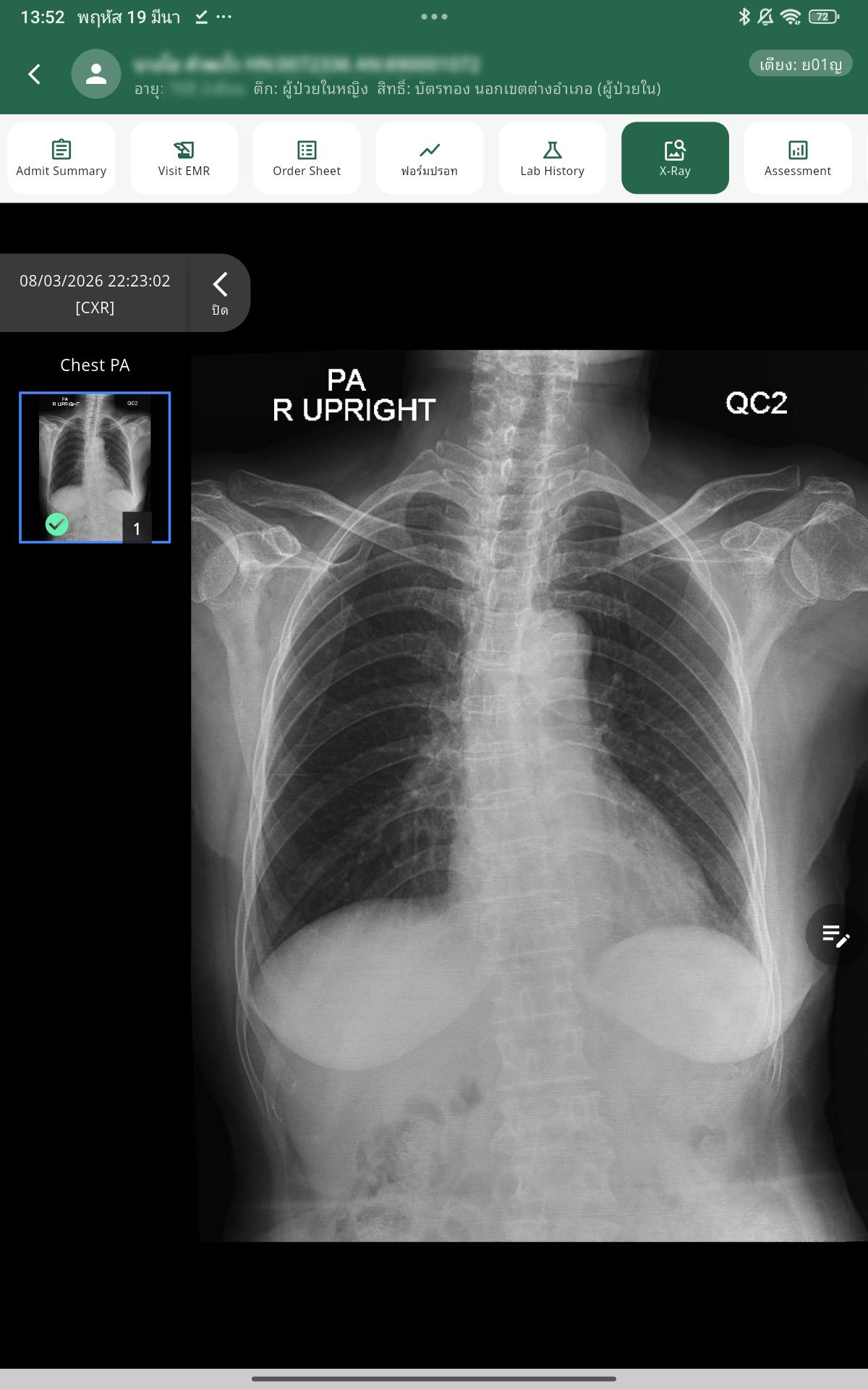 X-Ray
